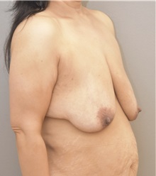 Breast Lift Before Photo by Keshav Magge, MD; Bethesda, MD - Case 37688
