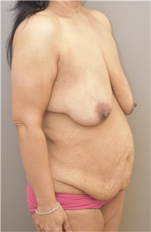 Tummy Tuck Before Photo by Keshav Magge, MD; Bethesda, MD - Case 37689