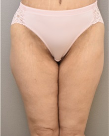 Thigh Lift After Photo by Keshav Magge, MD; Bethesda, MD - Case 37692