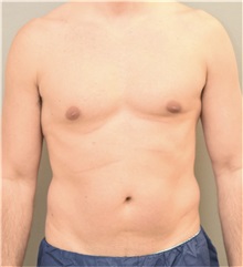 Liposuction Before Photo by Keshav Magge, MD; Bethesda, MD - Case 37706