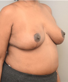 Breast Reduction After Photo by Keshav Magge, MD; Bethesda, MD - Case 37707