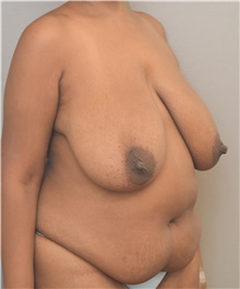 Breast Reduction Before Photo by Keshav Magge, MD; Bethesda, MD - Case 37707
