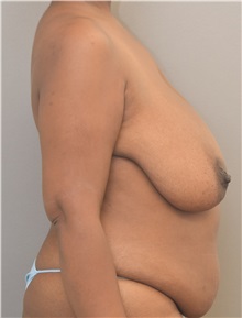 Breast Reduction Before Photo by Keshav Magge, MD; Bethesda, MD - Case 37707