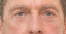 Eyelid Surgery After Photo by Keshav Magge, MD; Bethesda, MD - Case 37708