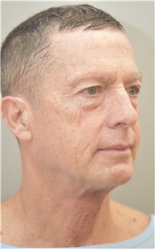 Facelift Before Photo by Keshav Magge, MD; Bethesda, MD - Case 37731