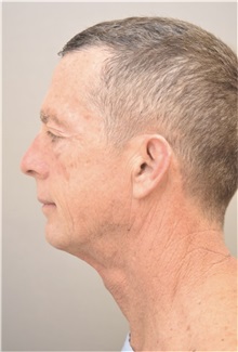 Facelift Before Photo by Keshav Magge, MD; Bethesda, MD - Case 37731