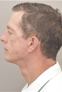 Neck Lift After Photo by Keshav Magge, MD; Bethesda, MD - Case 37732
