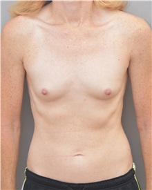 Breast Augmentation Before Photo by Keshav Magge, MD; Bethesda, MD - Case 37893