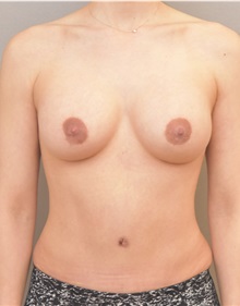 Breast Augmentation After Photo by Keshav Magge, MD; Bethesda, MD - Case 37895