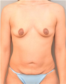 Breast Augmentation Before Photo by Keshav Magge, MD; Bethesda, MD - Case 37895