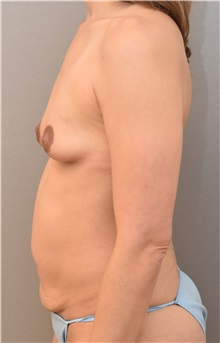 Tummy Tuck Before Photo by Keshav Magge, MD; Bethesda, MD - Case 37896