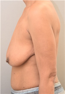Breast Lift Before Photo by Keshav Magge, MD; Bethesda, MD - Case 38562