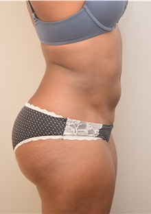 Liposuction After Photo by Keshav Magge, MD; Bethesda, MD - Case 38563