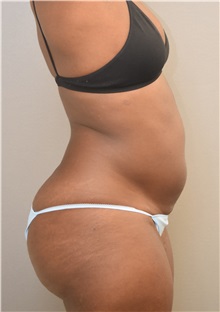 Liposuction Before Photo by Keshav Magge, MD; Bethesda, MD - Case 38563