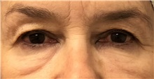 Eyelid Surgery Before Photo by Keshav Magge, MD; Bethesda, MD - Case 38565