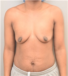 Breast Augmentation Before Photo by Keshav Magge, MD; Bethesda, MD - Case 38566