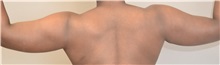 Liposuction Before Photo by Keshav Magge, MD; Bethesda, MD - Case 38567