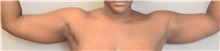 Liposuction Before Photo by Keshav Magge, MD; Bethesda, MD - Case 38567