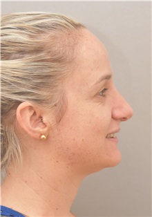 Rhinoplasty After Photo by Keshav Magge, MD; Bethesda, MD - Case 38569