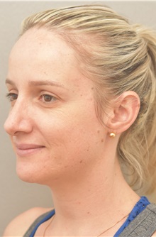 Rhinoplasty After Photo by Keshav Magge, MD; Bethesda, MD - Case 38569