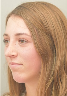 Rhinoplasty After Photo by Keshav Magge, MD; Bethesda, MD - Case 38570