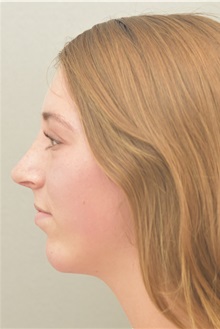 Rhinoplasty After Photo by Keshav Magge, MD; Bethesda, MD - Case 38570