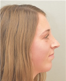 Chin Augmentation After Photo by Keshav Magge, MD; Bethesda, MD - Case 38571