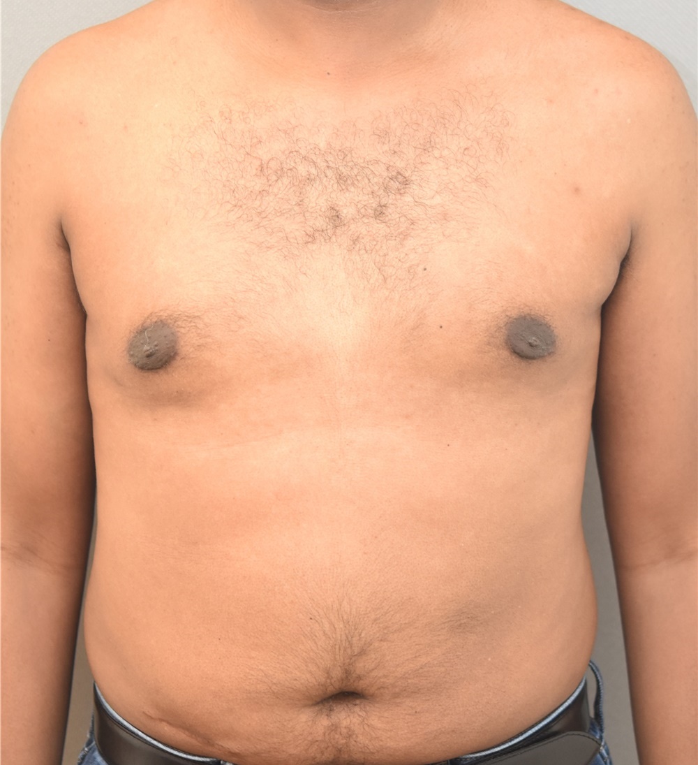 Male Breast Reduction Before and After Photos by Keshav Magge, MD; Bethesda,  MD - Case 38621