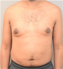 Male Breast Reduction Before Photo by Keshav Magge, MD; Bethesda, MD - Case 38621