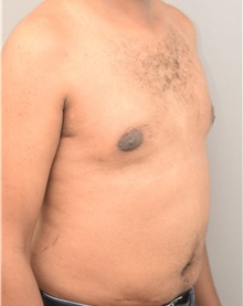 Male Breast Reduction After Photo by Keshav Magge, MD; Bethesda, MD - Case 38621