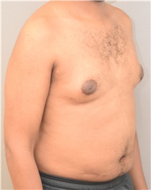 Male Breast Reduction Before Photo by Keshav Magge, MD; Bethesda, MD - Case 38621