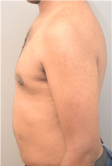 Male Breast Reduction After Photo by Keshav Magge, MD; Bethesda, MD - Case 38621