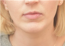 Chin Augmentation After Photo by Keshav Magge, MD; Bethesda, MD - Case 38622