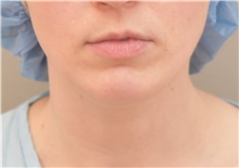 Chin Augmentation Before Photo by Keshav Magge, MD; Bethesda, MD - Case 38622
