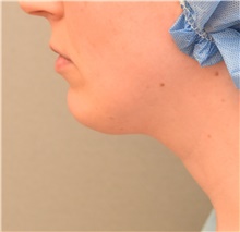 Chin Augmentation Before Photo by Keshav Magge, MD; Bethesda, MD - Case 38622