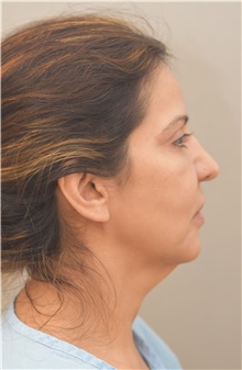 Facelift Before Photo by Keshav Magge, MD; Bethesda, MD - Case 38624