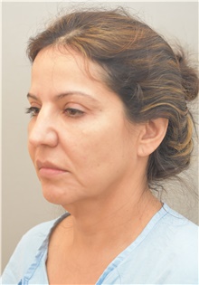 Facelift Before Photo by Keshav Magge, MD; Bethesda, MD - Case 38624