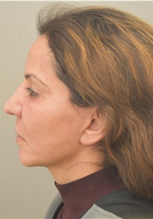 Neck Lift After Photo by Keshav Magge, MD; Bethesda, MD - Case 38625