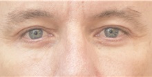 Eyelid Surgery After Photo by Keshav Magge, MD; Bethesda, MD - Case 38626