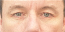 Eyelid Surgery Before Photo by Keshav Magge, MD; Bethesda, MD - Case 38626
