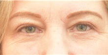 Eyelid Surgery After Photo by Keshav Magge, MD; Bethesda, MD - Case 38627