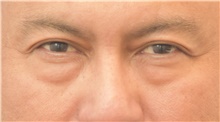 Eyelid Surgery Before Photo by Keshav Magge, MD; Bethesda, MD - Case 38628