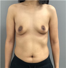 Breast Augmentation Before Photo by Keshav Magge, MD; Bethesda, MD - Case 38631
