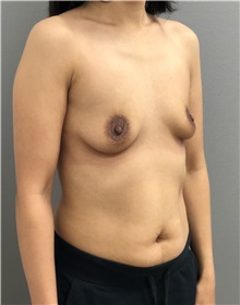 Breast Augmentation Before Photo by Keshav Magge, MD; Bethesda, MD - Case 38631