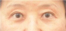 Eyelid Surgery After Photo by Keshav Magge, MD; Bethesda, MD - Case 38632