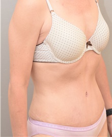 Tummy Tuck After Photo by Keshav Magge, MD; Bethesda, MD - Case 38635