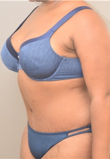 Tummy Tuck After Photo by Keshav Magge, MD; Bethesda, MD - Case 38637