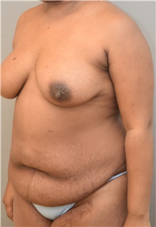 Tummy Tuck Before Photo by Keshav Magge, MD; Bethesda, MD - Case 38637