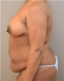 Tummy Tuck Before Photo by Keshav Magge, MD; Bethesda, MD - Case 38637