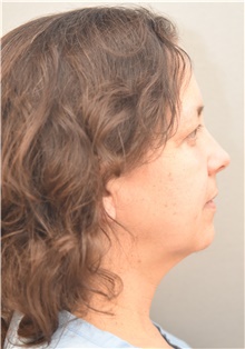 Facelift Before Photo by Keshav Magge, MD; Bethesda, MD - Case 38638